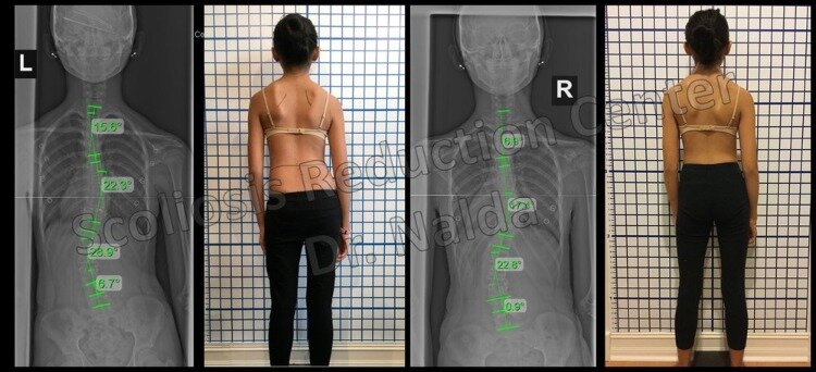 Pre Post Scoliosis Treatment X-Ray