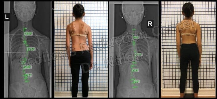 Pre Post Scoliosis Treatment X-Ray