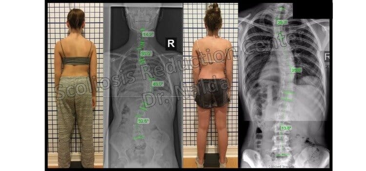 Pre Post Scoliosis Treatment X-Ray