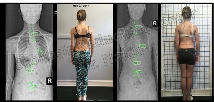 Pre Post Scoliosis Treatment X-Ray