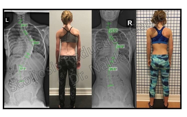 Pre Post Scoliosis Treatment X-Ray