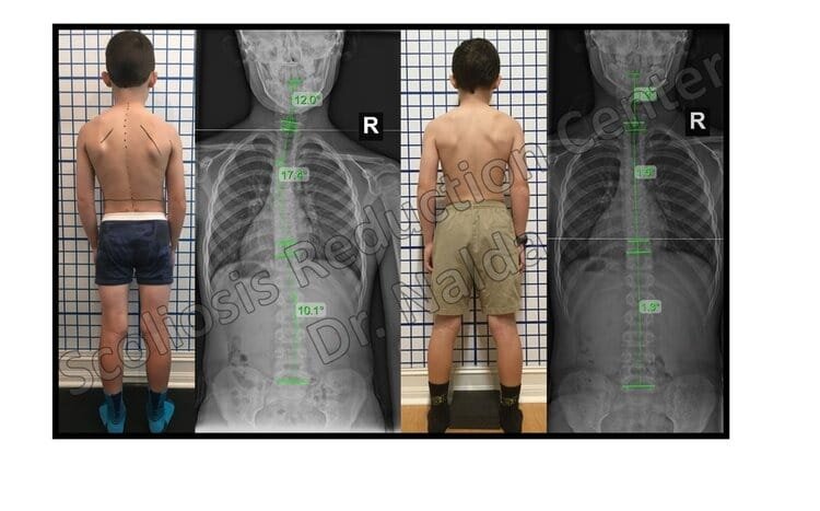 Pre Post Scoliosis Treatment X-Ray