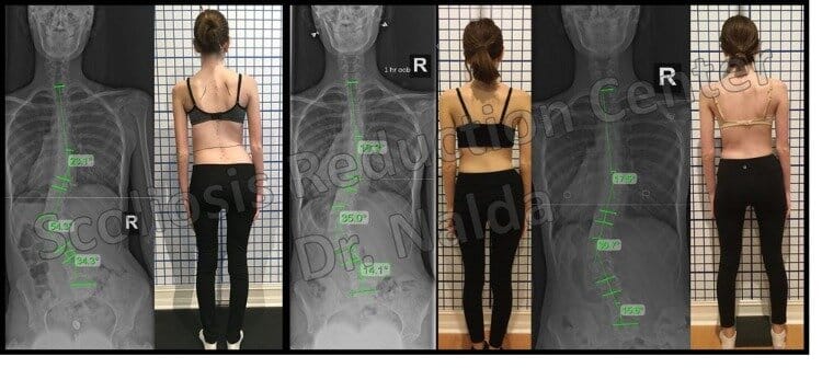 Pre Post Scoliosis Treatment X-Ray