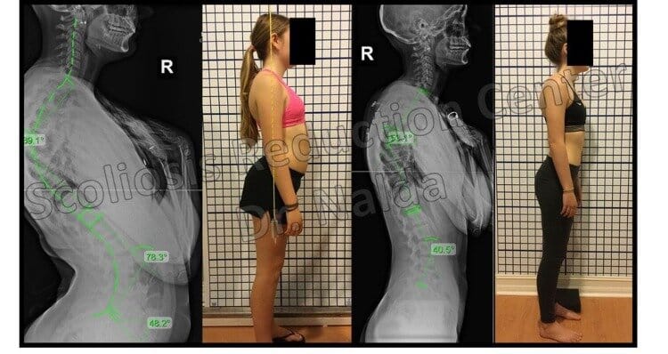 Pre Post Scoliosis Treatment X-Ray