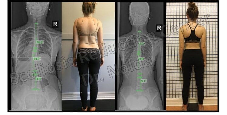 Pre Post Scoliosis Treatment X-Ray