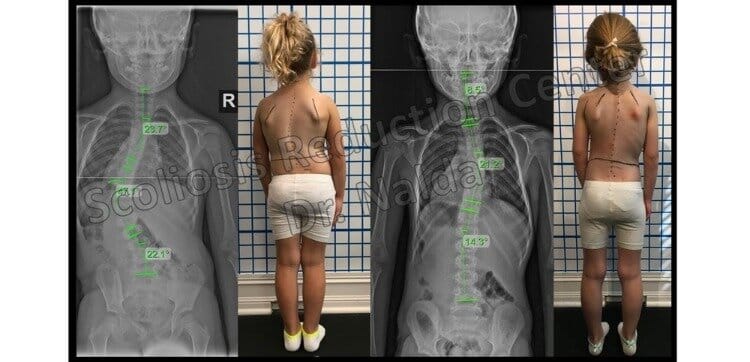 Pre Post Scoliosis Treatment X-Ray