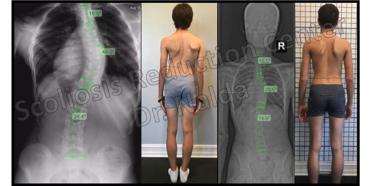 Pre Post Scoliosis Treatment X-Ray