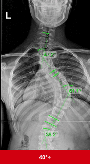 Severe Scoliosis