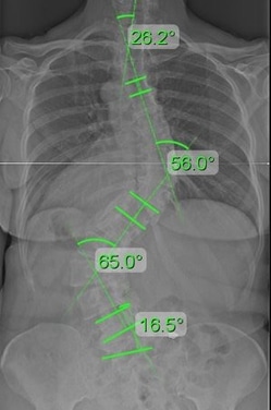 elderly 1 week treatment