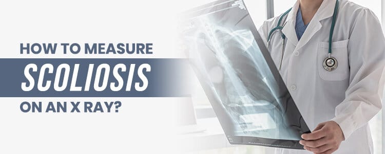 how tomeasure scoliosis on an xray