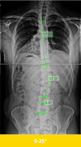 mild scoliosis x ray