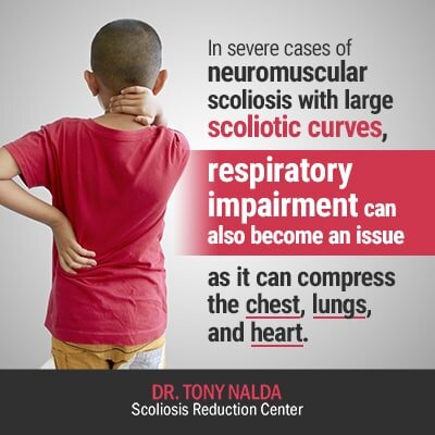 in severe cases of neuromuscular scoliosis