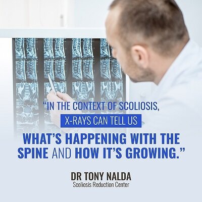 in the context of scoliosis small