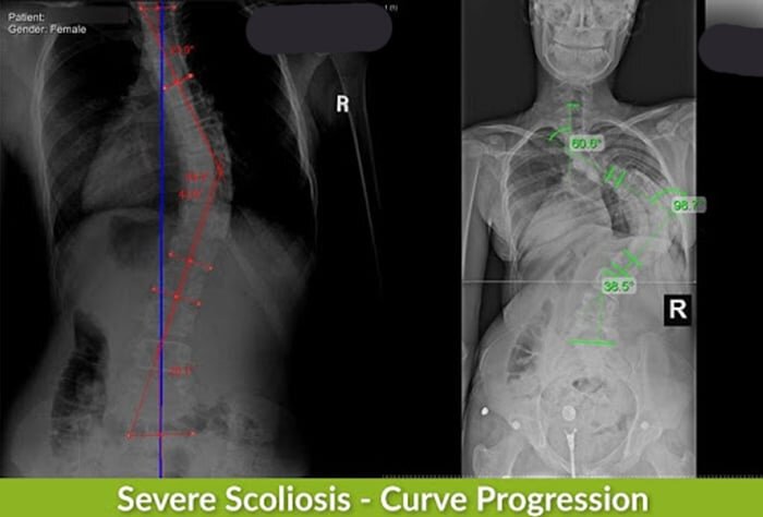 kathy severe scoliosis curve xrays
