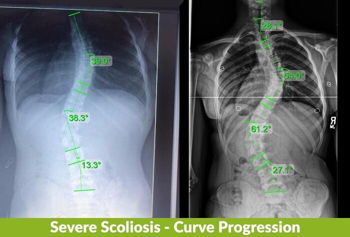 mary severe scoliosis curve xrays