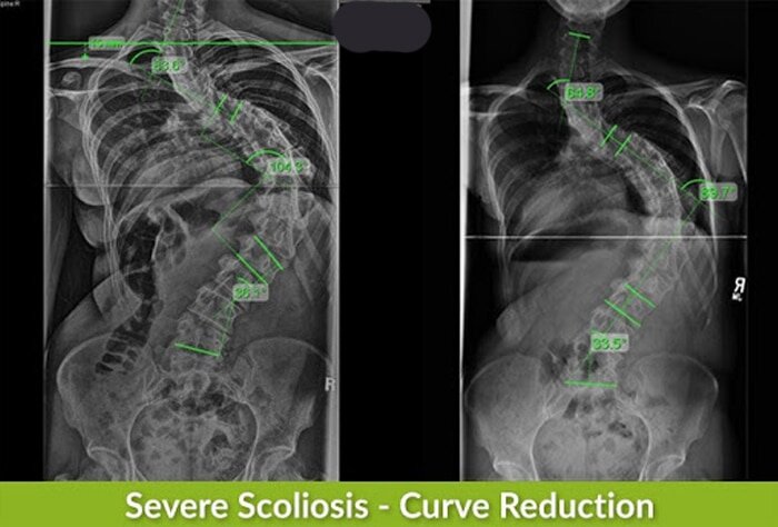 melanie severe scoliosis curve xrays