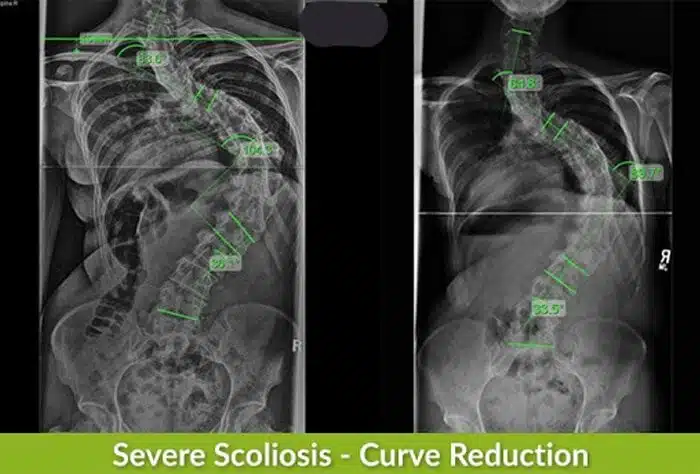 bad-scoliosis-x-ray
