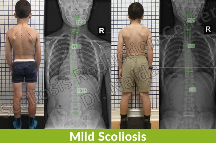 mild scoliosis correction