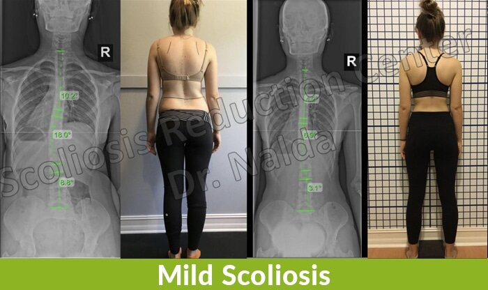 mild scoliosis correction