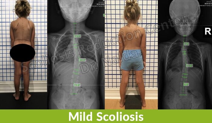 mild scoliosis correction