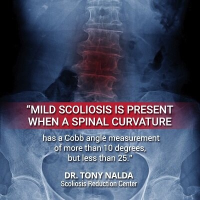 mild scoliosis is present small