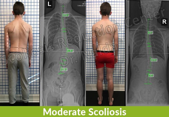 moderate scoliosis reduction