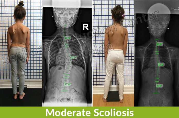 moderate scoliosis reduction