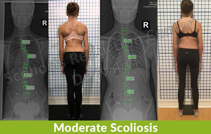 moderate scoliosis reduction