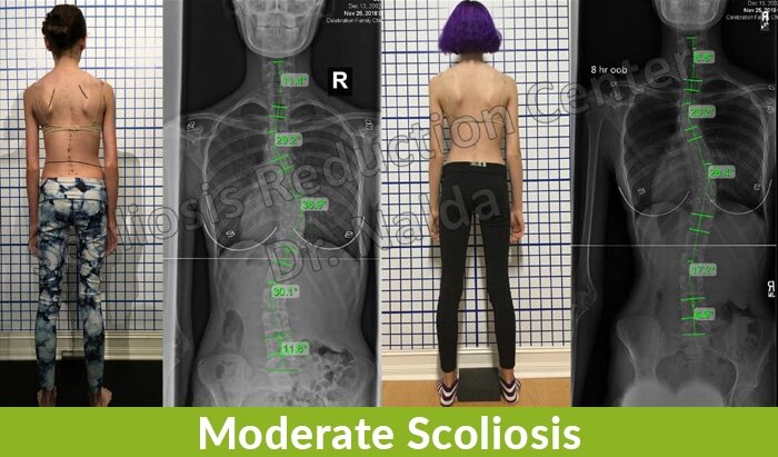 moderate scoliosis reduction