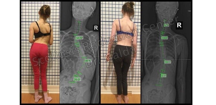 Pre Post Scoliosis Treatment X-Ray