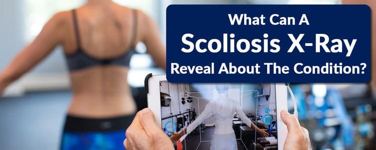 What Can a Scoliosis X-Ray Reveal about the Condition?