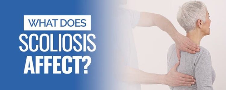 what does scoliosis affect