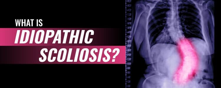 What is Idiopathic Scoliosis?