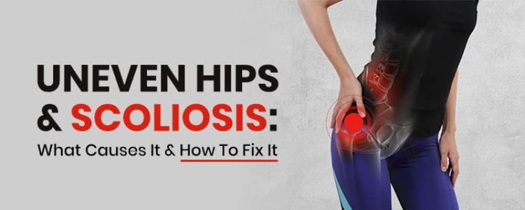 uneven hips scoliosis