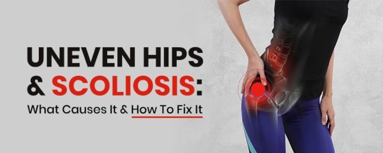 uneven hips scoliosis