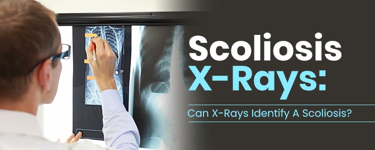 mild scoliosis x ray