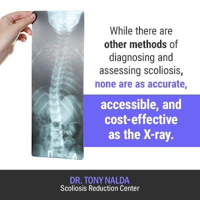 mild scoliosis x ray