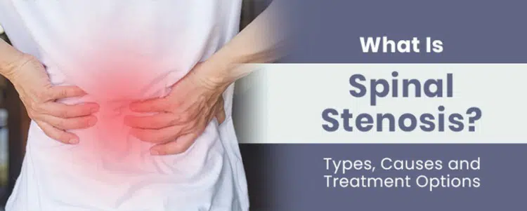 https://www.scoliosisreductioncenter.com/wp-content/uploads/2021/10/what-is-spinal-stenosis.jpg.webp