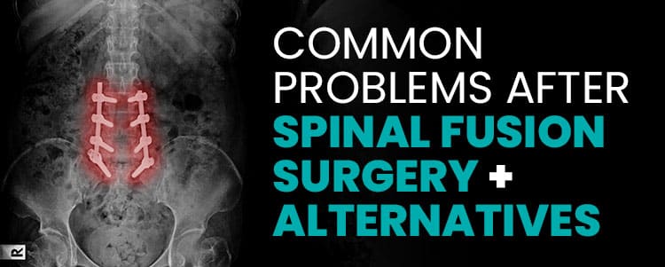 Common Problems After Spinal Fusion Surgery + Alternatives