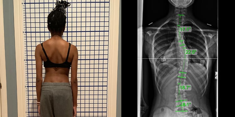 adolescent mild scoliosis