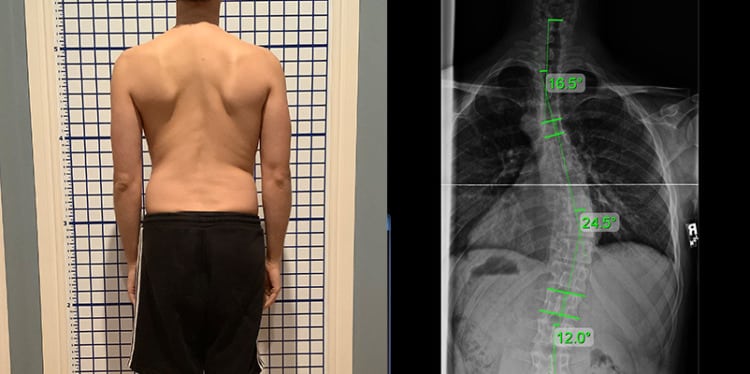 adult mild scoliosis