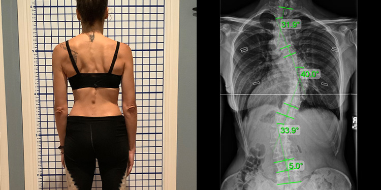 adult severe scoliosis
