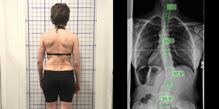 moderate scoliosis adult
