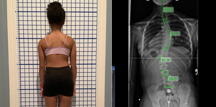 moderate scoliosis