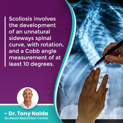 Scoliosis involves the development of 400