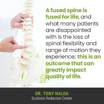 A fused spine is fused 