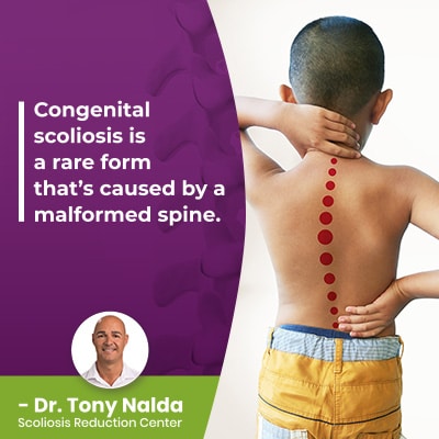 congenital scoliosis is a 400