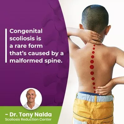 congenital scoliosis is a 400 congenital scoliosis is a 400