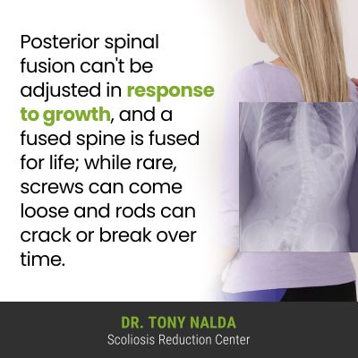 posterior spinal fusion cant 400