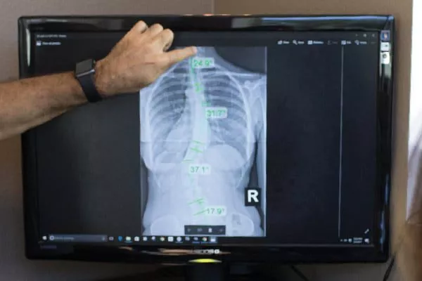 about scoliosis about scoliosis